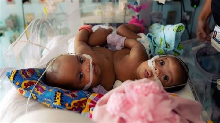 Amanda Arciniega And James Finley’s Conjointed Twins Separated, Meet JamieLynn and AmieLynn