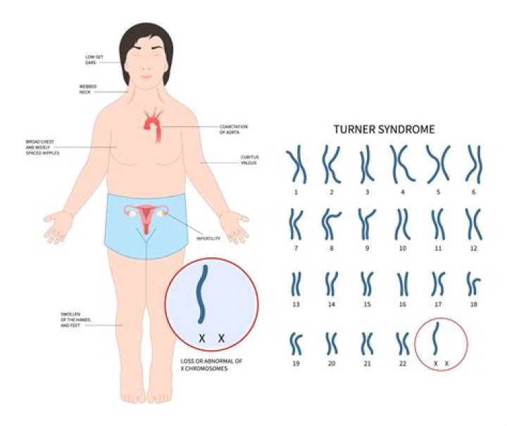 Are down and Klinefelter syndromes chromosomal abnormalities?