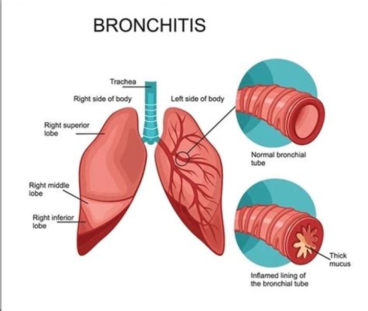 Are steam rooms good for bronchitis?