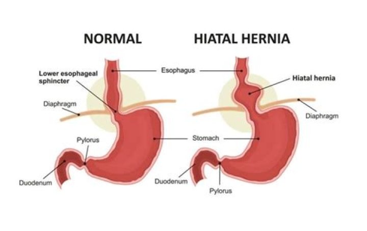 Can a hiatal hernia affect the vagus nerve?
