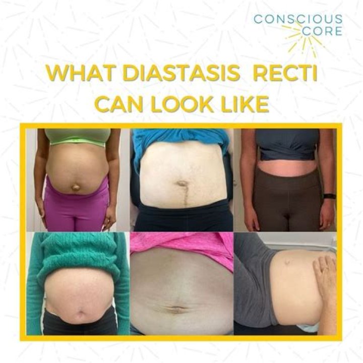 Can Diastasis Recti cause digestive problems?