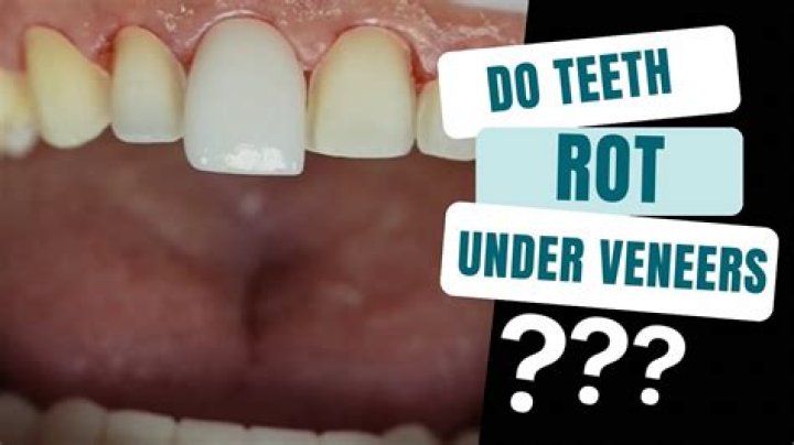 Do iron pills rot your teeth?