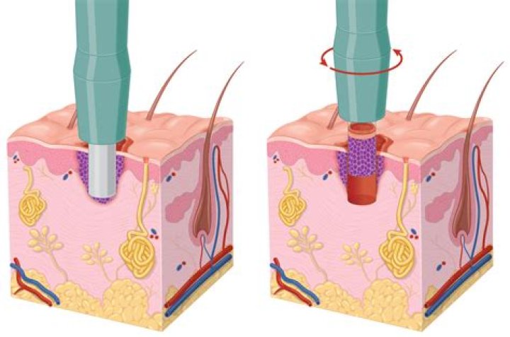 Does Aetna cover abdominoplasty?