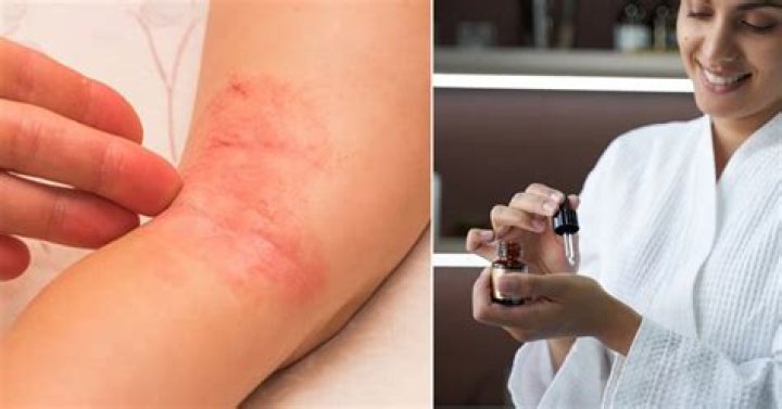 Does castor oil kill Candida?