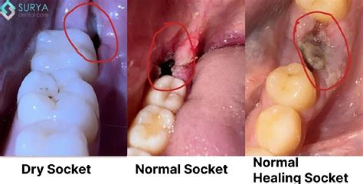 Does dry ice work on dents?