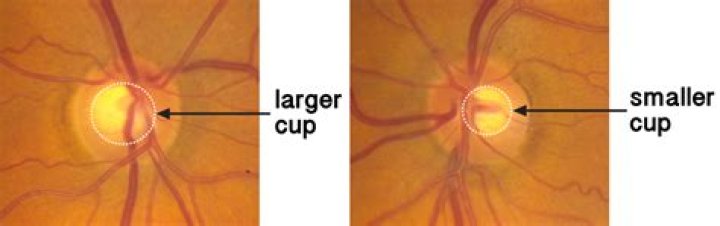 Does large optic nerve mean glaucoma?