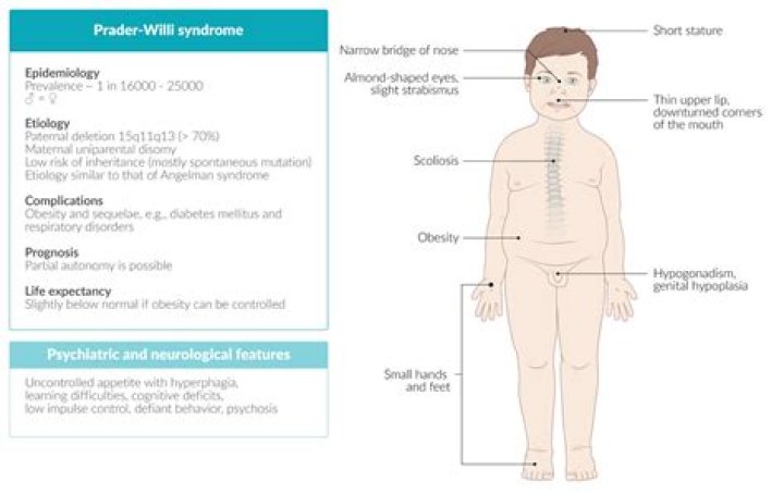 Does Mayim Bialik have prader-willi syndrome?