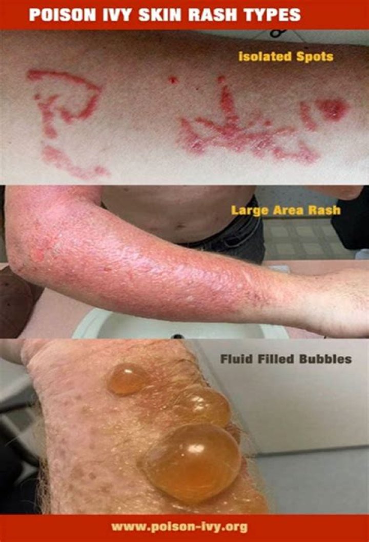 Does sweat make poison ivy worse?