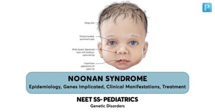 Does William H Macy have Noonan syndrome?