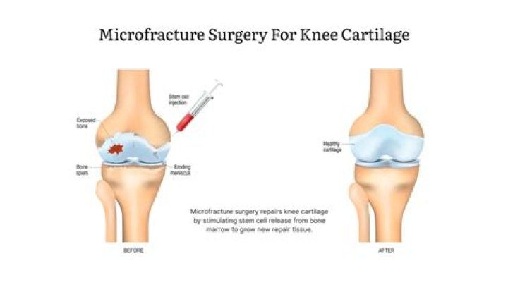 How long does knee microfracture take to heal?