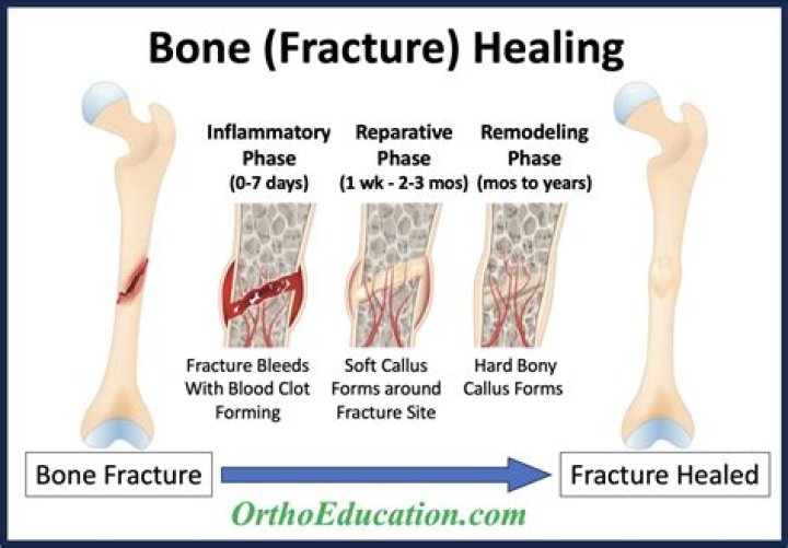 In which type of fracture does the bone injure another organ?