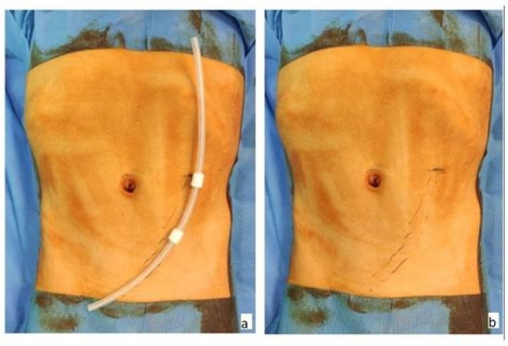 Is a peritoneal dialysis catheter considered a surgical wound on Oasis?