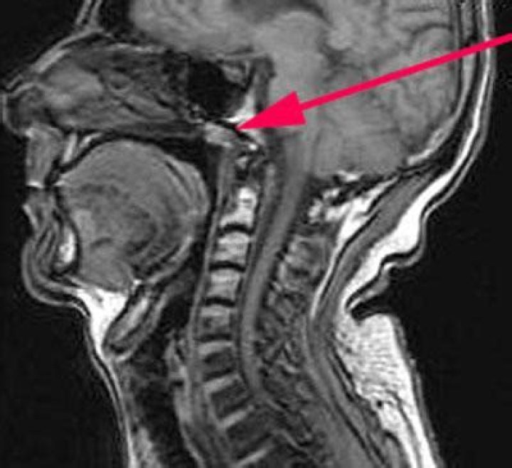 Is a Thornwaldt cyst dangerous?