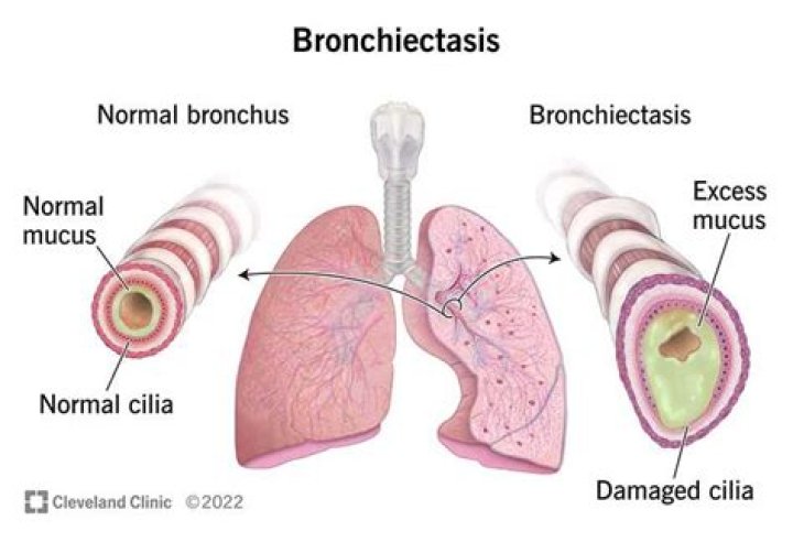 Is an excessive discharge of mucus from the bronchi?