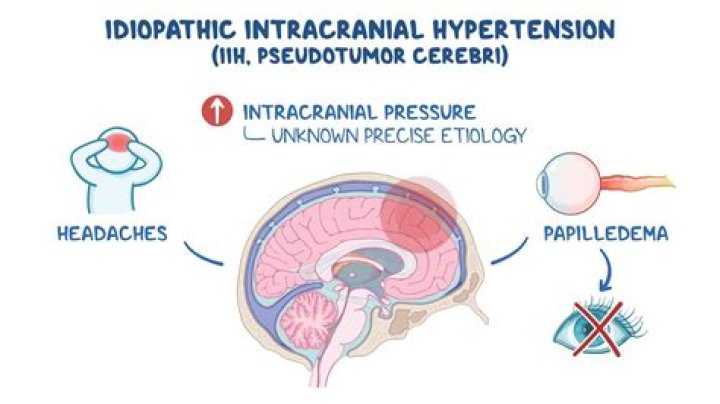Is idiopathic intracranial hypertension an autoimmune disease?