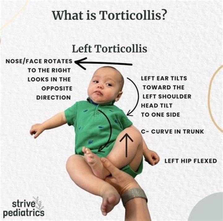 Is torticollis a disability?