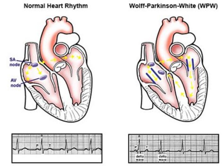 Is Wolff Parkinson White Syndrome dangerous?