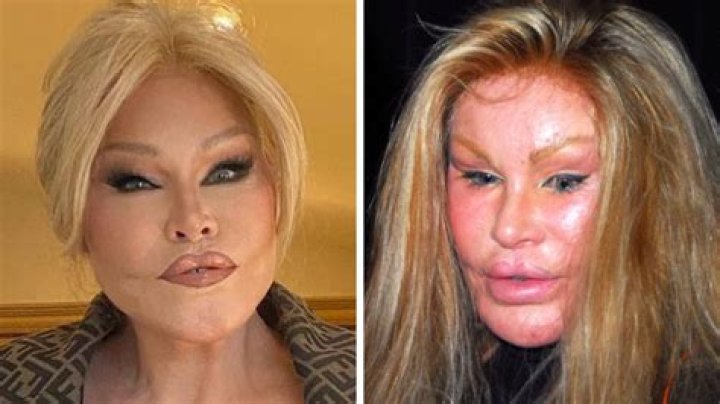Jocelyn Wildenstein Plastic Surgery Gone Wrong! Before And After Photos