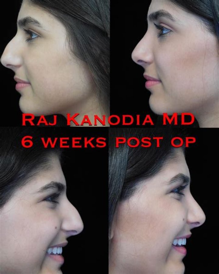 Raj Kanodia rhinoplasty cost