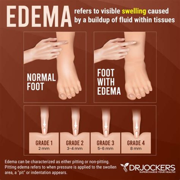 What are the main causes of edema quizlet?