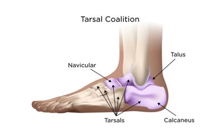 What causes a tarsal boss?