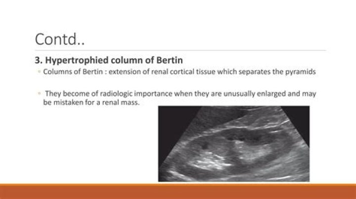 What causes hypertrophied column of Bertin?
