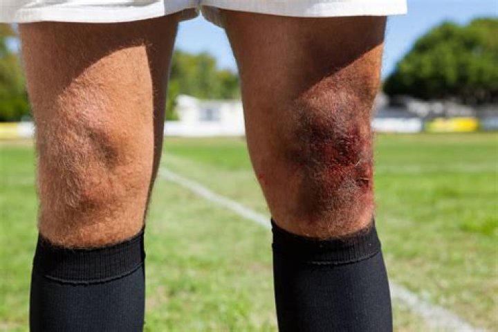 What causes turf burn?
