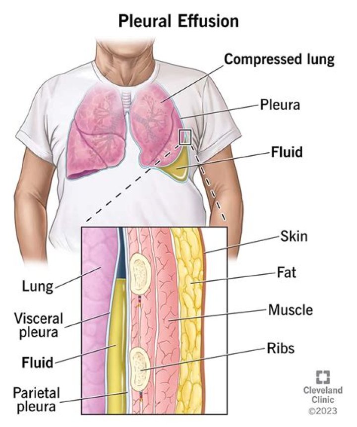 What causes unilateral pleural effusion?