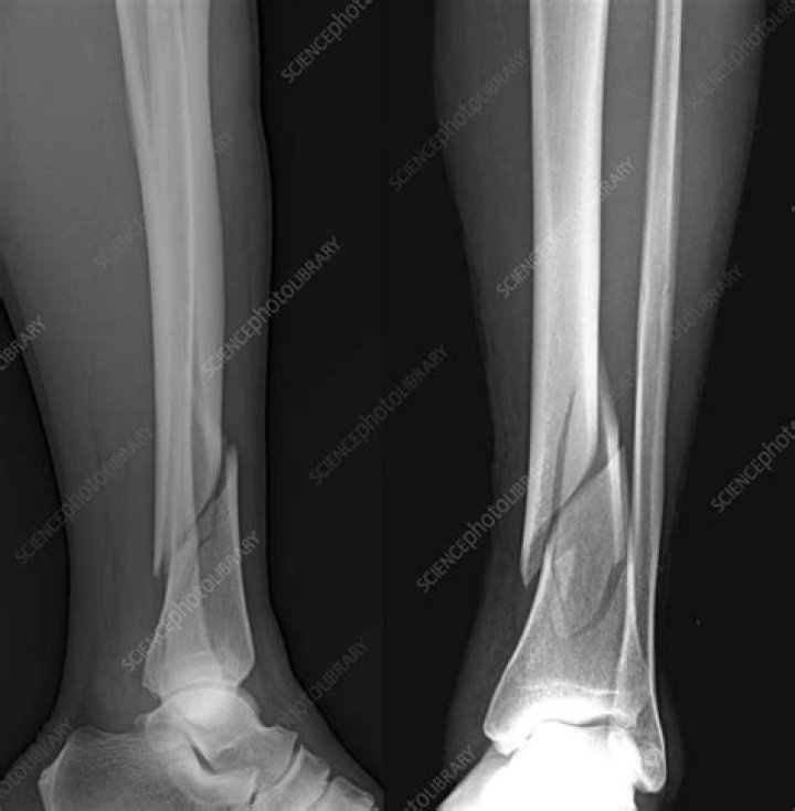 What does a fracture look like on an X ray?