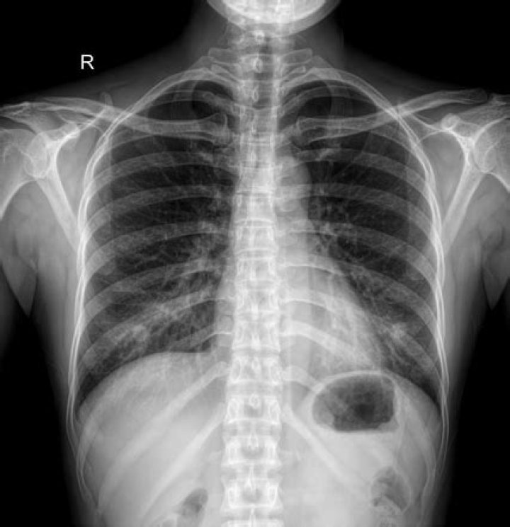 What does a nipple shadow mean?