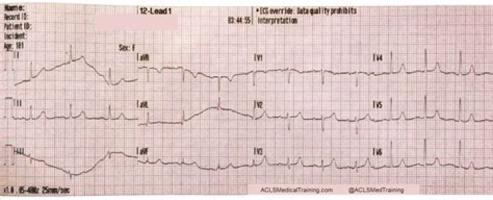 What does artifact mean on ECG?