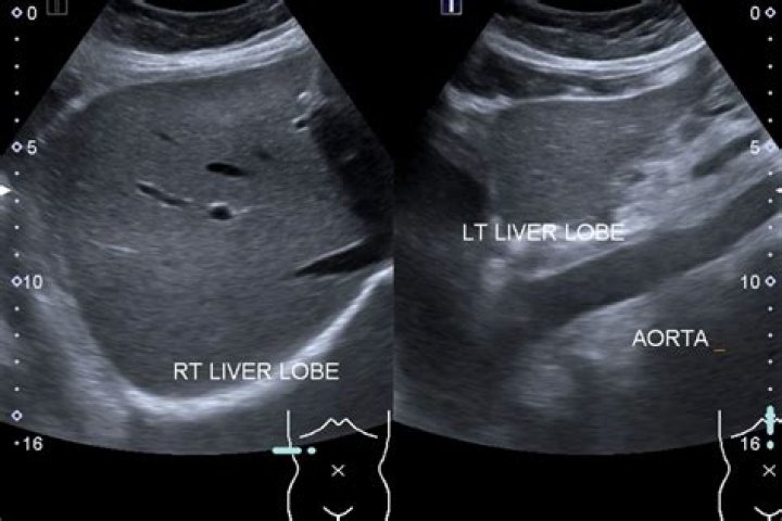 What does coarse texture in liver ultrasound mean?