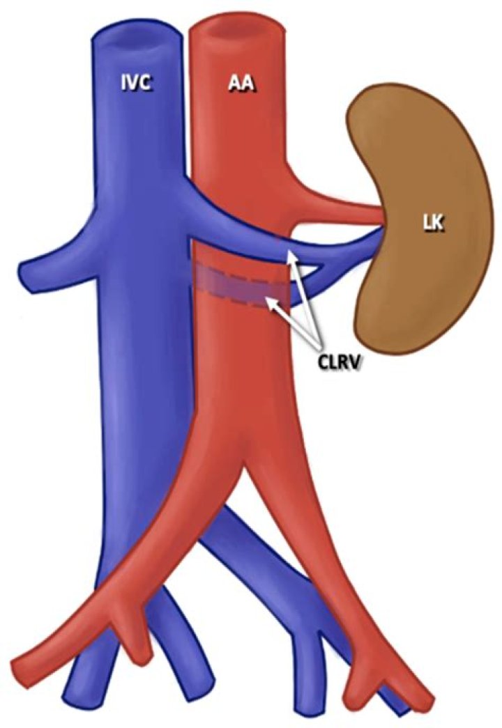 What does incidental Circumaortic left renal vein mean?