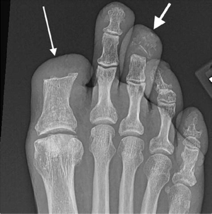 What does osteomyelitis look like on xray?