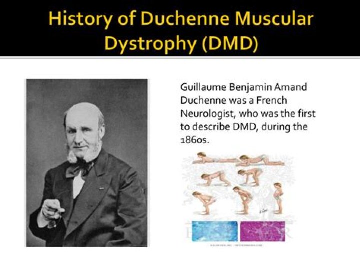 What famous people have Duchenne muscular dystrophy?