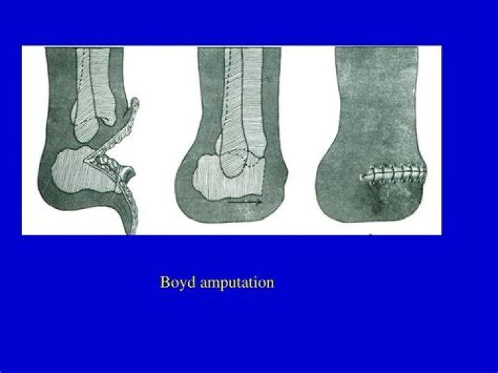 What is a Boyd amputation?