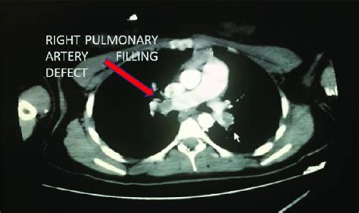 What is a filling defect in lung?