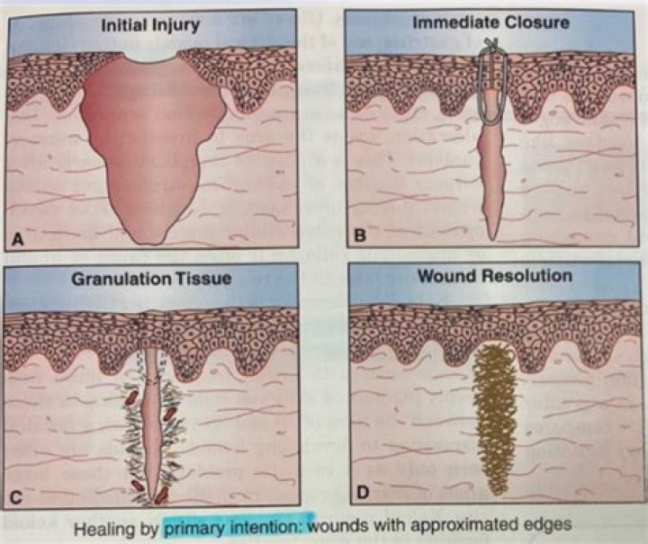 What is a gaping wound?