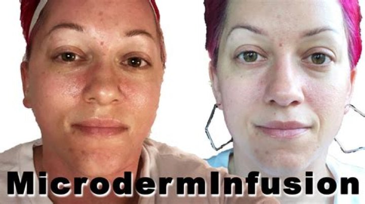 What is a Microderm infusion?