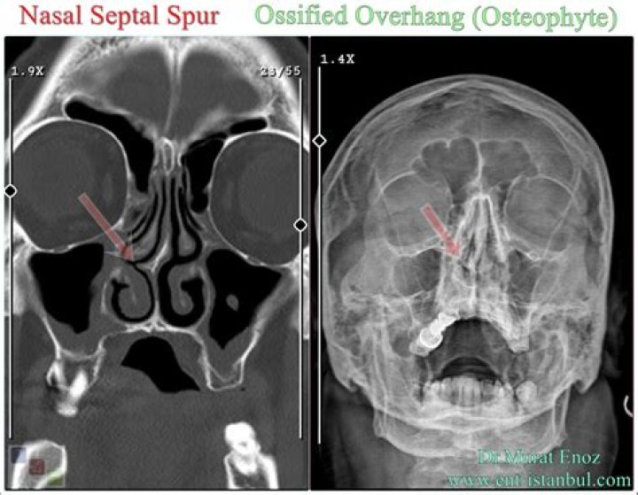 What is a nasal bone spur?