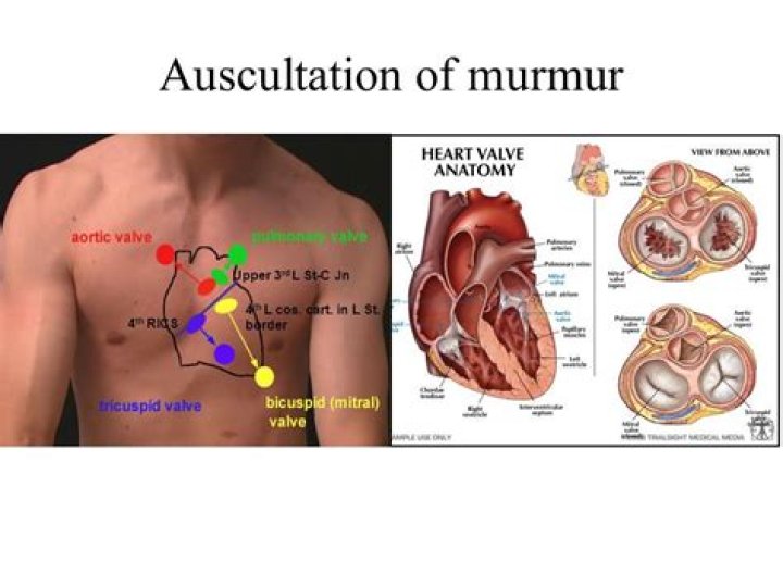 What is a PPS murmur?