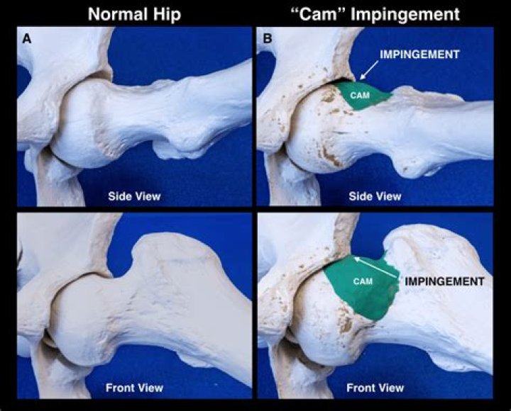 What is cam type morphology?