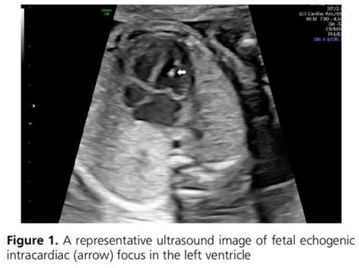 What is echogenic focus in left ventricle?