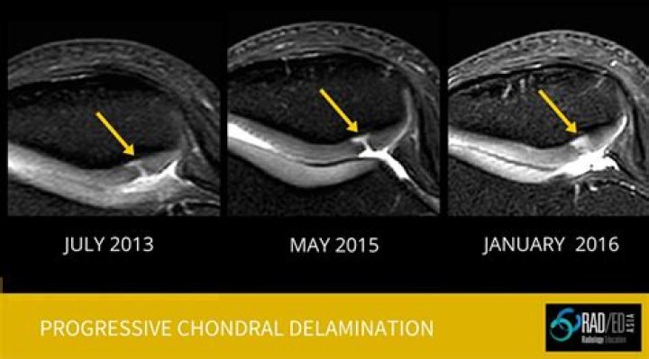 What is full thickness Chondrosis?