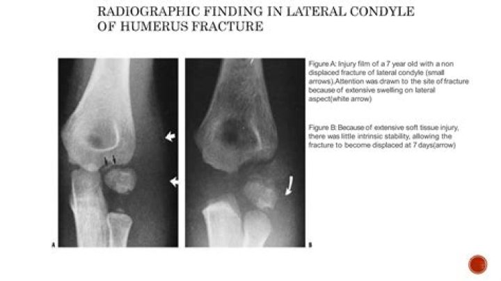 What is Hume fracture?