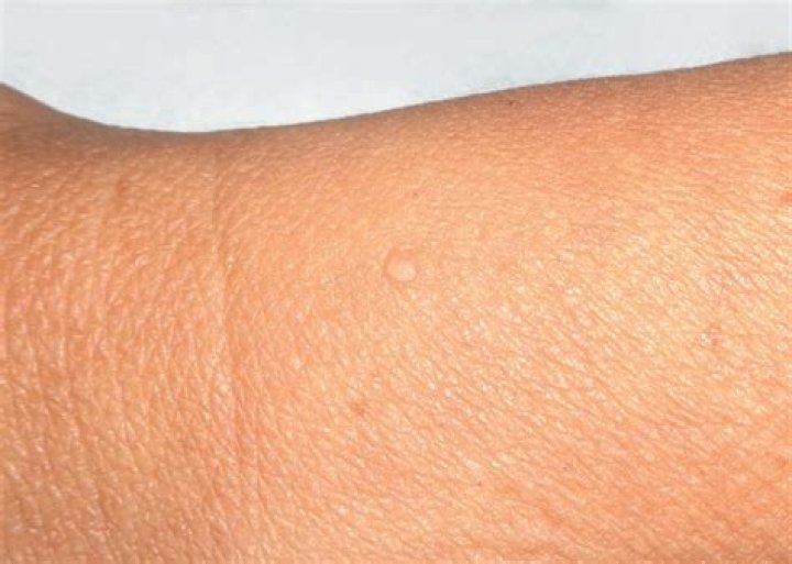 What is Mucinosis skin?
