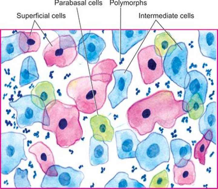 What is parabasal cells on Pap smear?