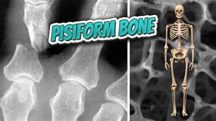 What is Pisiformectomy?