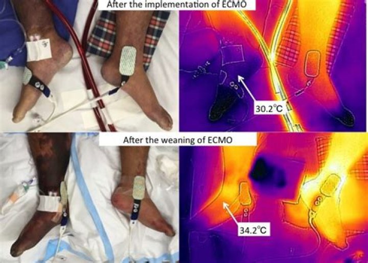 What is Poikilothermia in compartment syndrome?
