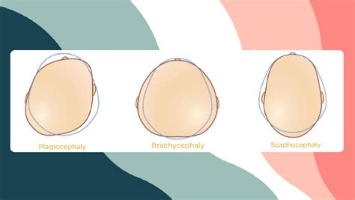 What is severe plagiocephaly?